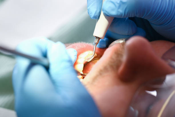 Best Emergency Root Canal Treatment in Davidson, NC